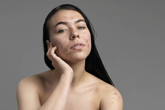 El riesgo del autocuidado equivocado de la piel con acné